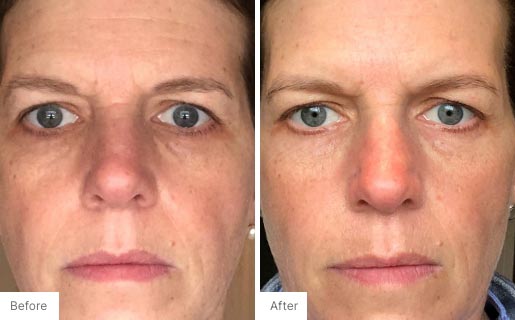 7 - Before and After Real Results of Age IQ Day Cream on a woman's face